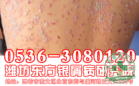 银屑病患者的秋季防护工作应该做好哪一些？