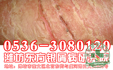 银屑病使用药物要知道什么?