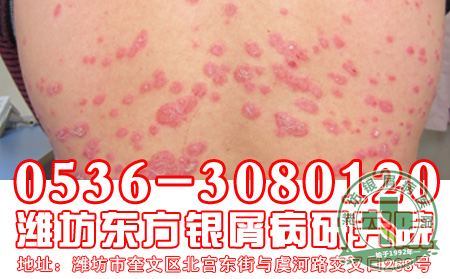 银屑病患者应该多吃哪些食物？