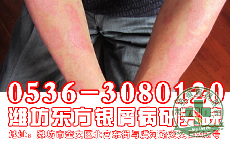 银屑病患者的饮食适宜怎样做？