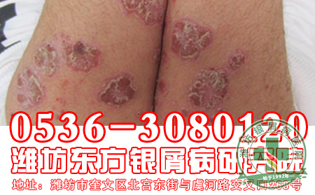 对于银屑病的发病危害患者应该知道哪些?
