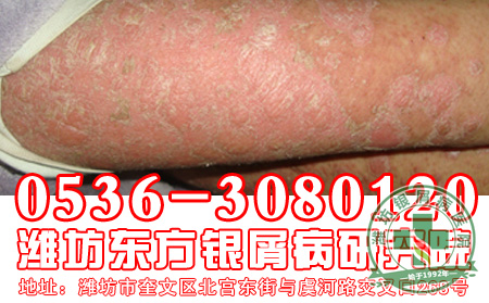 银屑病患者怎样治疗 好？