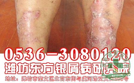 对于银屑病的遗传患者应该了解什么?
