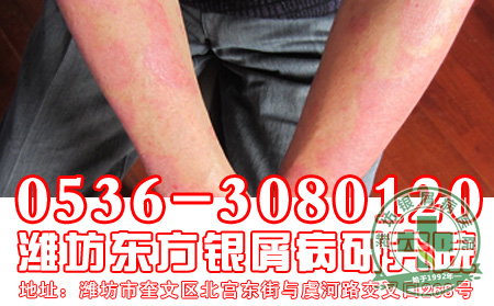 对于银屑病的后代遗传患者应该了解哪些?