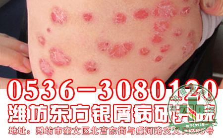 对于银屑病的遗传患者还应该知道什么?