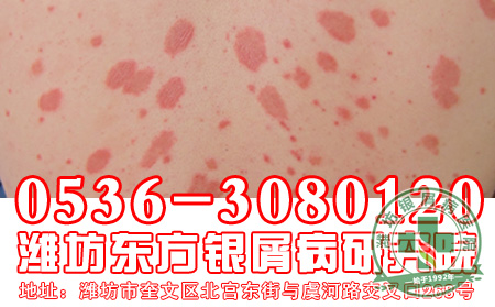 银屑病患者用药要注意什么问题?
