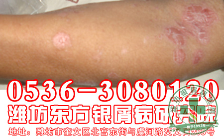 银屑病患者药物选择要注意什么问题?