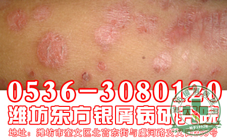 银屑病治疗过程中做好哪些防护工作是非常有必