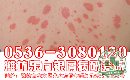 银屑病的护理工作应该怎么做？