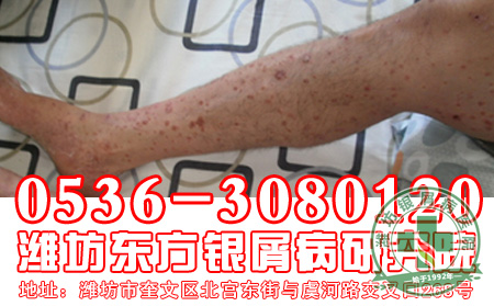 对于银屑病患者的饮食应该注意哪一些?