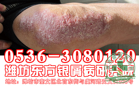 对于比较严重的银屑病患者应该怎样对待发病危