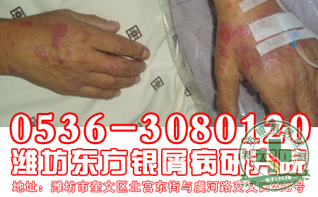 牛皮癣的饮食要做好什么注意工作？