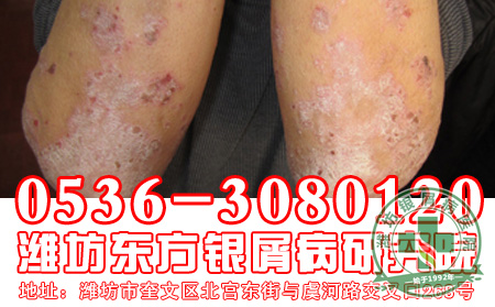 银屑病在遗传过程中患者应该注意什么?
