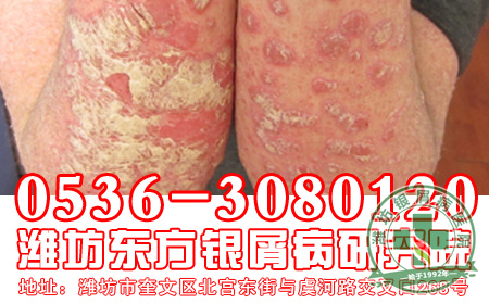 银屑病治疗为什么要避免使用外用药物？