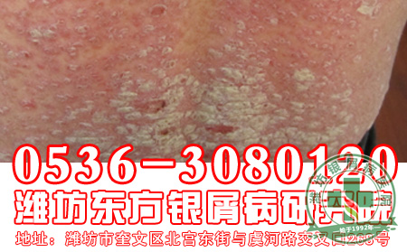 银屑病治疗患者要注意哪些事情？