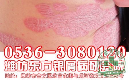 银屑病患者使用药物要注意什么?