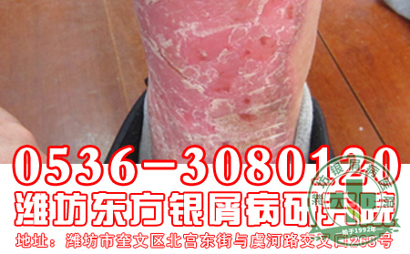 对于银屑病的遗传患者应该注意到哪些问题?