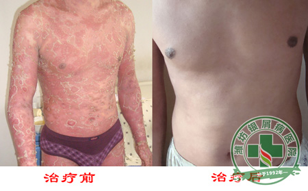 银屑病的治疗方法有哪些