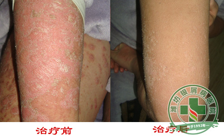 银屑病患者适合吃什么水果