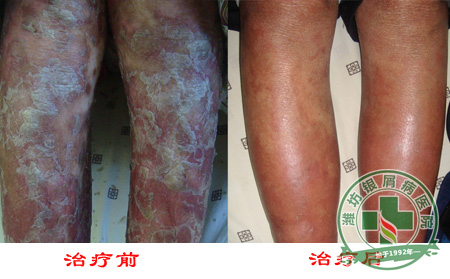 寻常型银屑病的临床表现