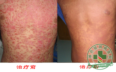 寻常型银屑病怎么治疗 好