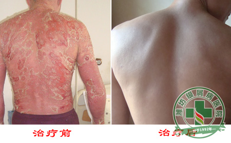 银屑病的发病原因有什么