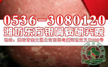 怎样科学治疗老年牛皮癣？