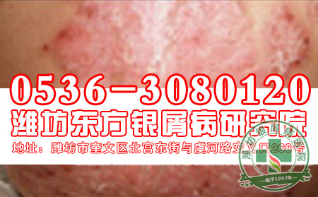 怎样有效的预防牛皮癣？