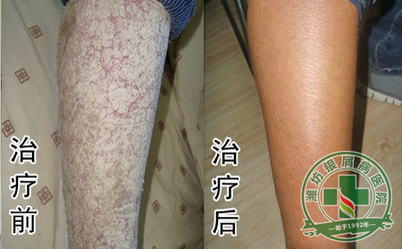 牛皮癣发病跟血液有何关系？