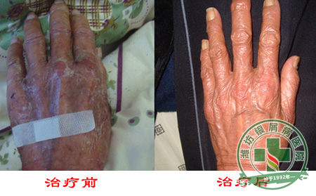 关节型银屑病的发病因素