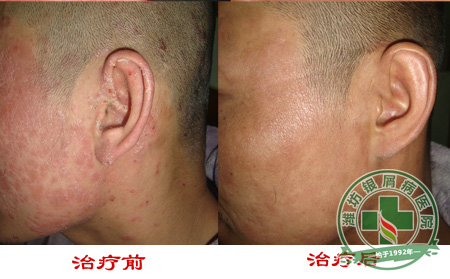 激素治疗银屑病危害有哪些方面?