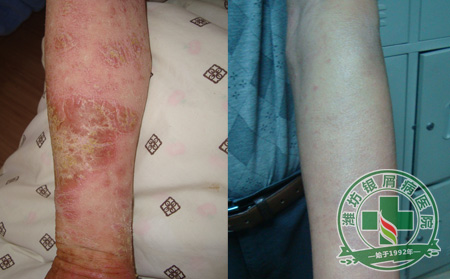 SP-R绿色净肤疗法