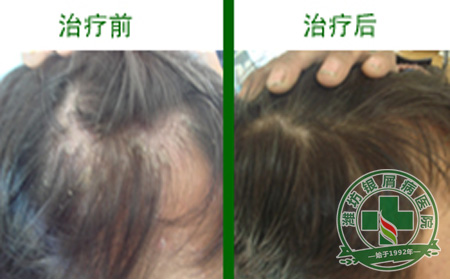 头部牛皮癣治疗时要注意哪些事项？
