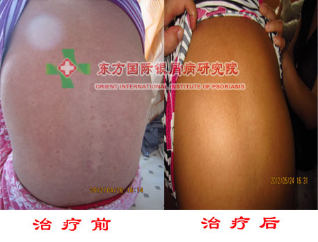 牛皮癣消退期带来哪些症状表现?
