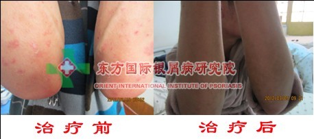 怎么诊断寻常型银屑病 好？