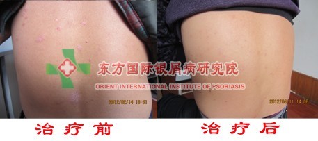 喝粥对于寻常型银屑病治疗好吗？