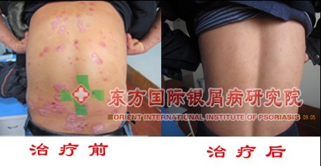寻常型牛皮癣的不同形态症状表现?
