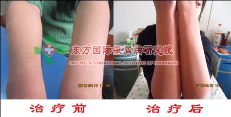 容易患上牛皮癣会有哪些人?