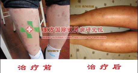 预防牛皮癣从哪方面入手？