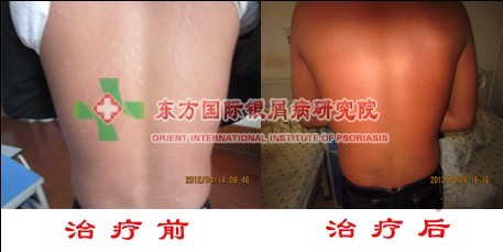 环境不好跟牛皮癣病发有关吗?
