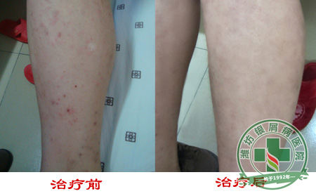血型跟引发牛皮癣有关吗?