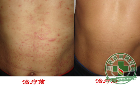 治疗脓疱型银屑病要注意些什么呢？