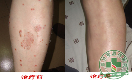 银屑病使用小偏方的危害有哪些?