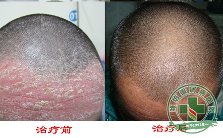 银屑病患者用药常识有哪些