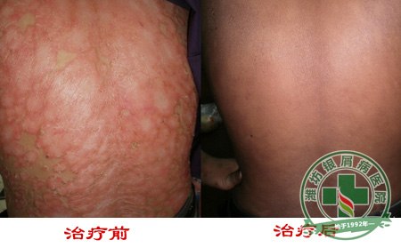 粘膜型银屑病症状常见于哪些部位?