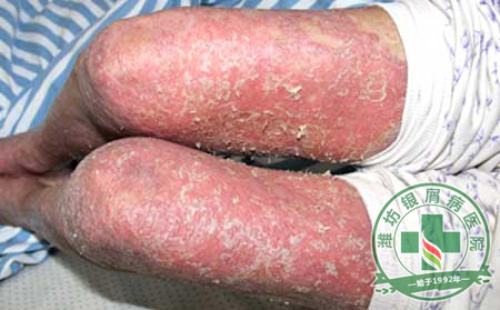 脓疱型银屑病该如何去预防？