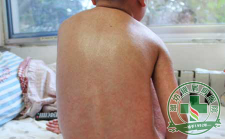 银屑病病发小腿的症状表现