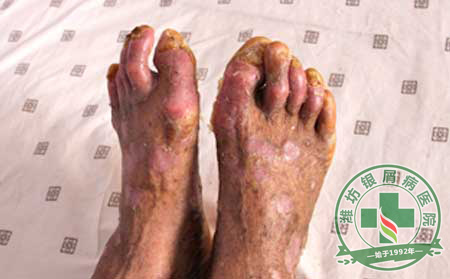 炎热季节银屑病患者如何护理？