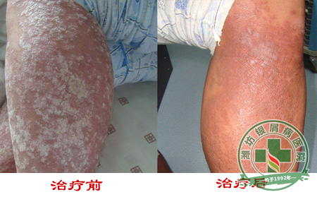 全面概述:关节型银屑病