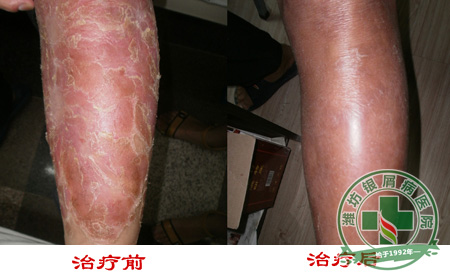 牛皮癣红斑变大是病情加重吗？